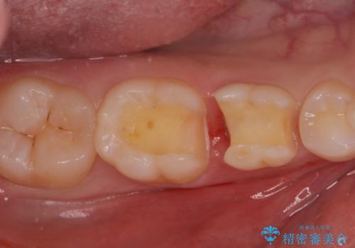 歯が染みる。セラミックインレー治療。の治療中