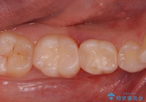 歯が染みる。セラミックインレー治療。の治療後
