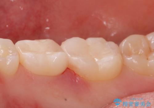 歯が染みる。セラミックインレー治療。の治療後