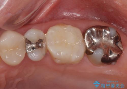 【銀歯を無くしたい】 メタルフリー治療