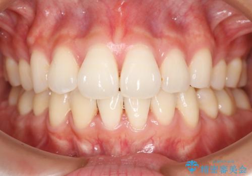 裏側装置で目立たず矯正!の症例 治療後