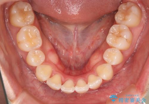 裏側装置で目立たず矯正!の治療後