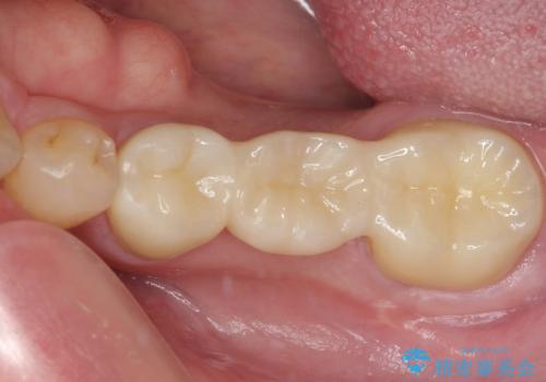 外れやすい銀歯をどうにかしたい。フルジルコニアブリッジによる補綴の症例 治療後