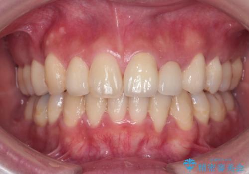 前歯の審美的なブリッジ (歯列矯正後)の症例 治療後