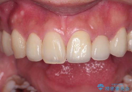 前歯の審美的なブリッジ (歯列矯正後)の治療後