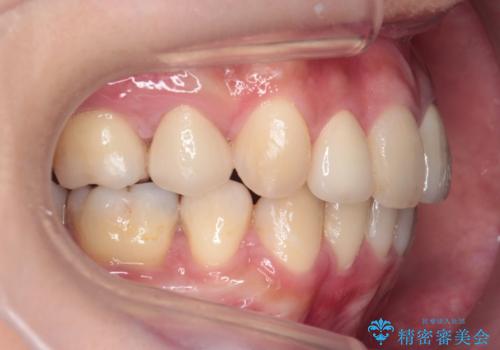 重度のがたつき 矯正治療+セラミック治療で綺麗な歯並びに 矯正専門では難しい治療の治療後