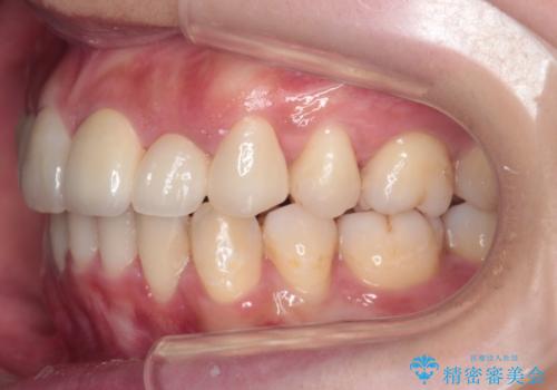重度のがたつき 矯正治療+セラミック治療で綺麗な歯並びに 矯正専門では難しい治療の治療後