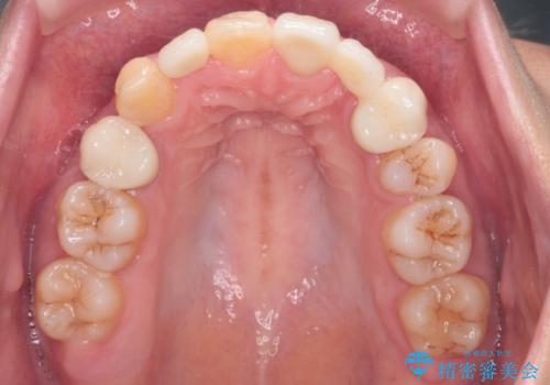 重度のがたつき　矯正治療+セラミック治療で綺麗な歯並びに　矯正専門では難しい治療の治療後