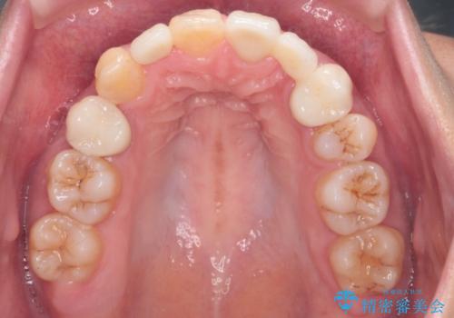 重度のがたつき 矯正治療+セラミック治療で綺麗な歯並びに 矯正専門では難しい治療の治療後