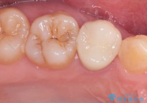 奥歯の神経のない歯をセラミックでしっかり治療の症例 治療後