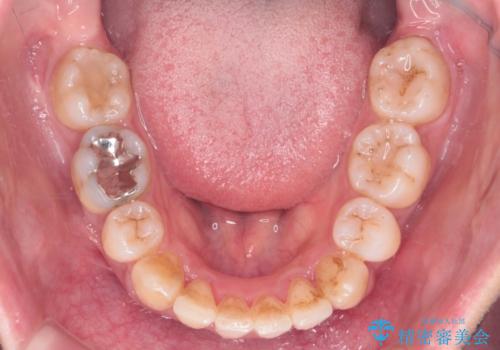 重度のがたつき 矯正治療+セラミック治療で綺麗な歯並びに 矯正専門では難しい治療の治療後