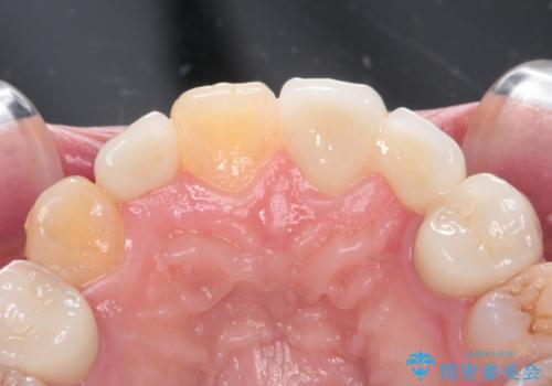 前歯の審美的なブリッジ (歯列矯正後)の治療後