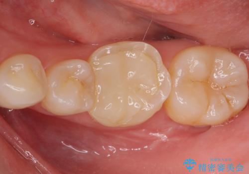 白い被せ物を入れたい。の症例 治療前