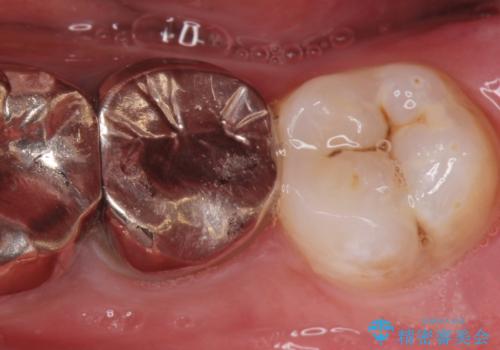 まっすぐ生えた親知らず抜歯の治療前