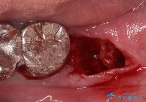 まっすぐ生えた親知らず抜歯の治療後