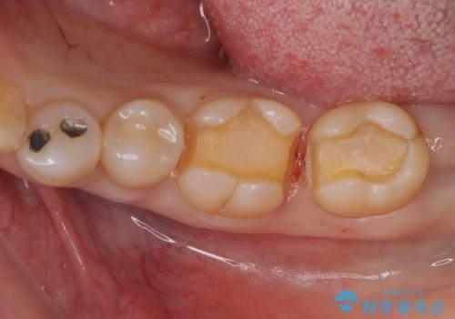 アマルガムを除去 虫歯を除去して、セラミックのつめものにの治療中