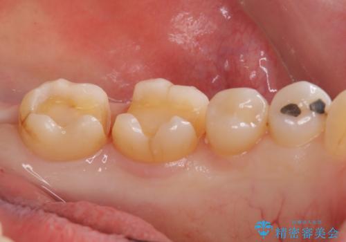 アマルガムを除去 虫歯を除去して、セラミックのつめものにの治療中
