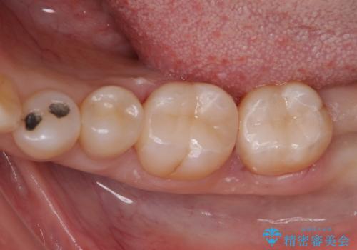 アマルガムを除去 虫歯を除去して、セラミックのつめものにの症例 治療後