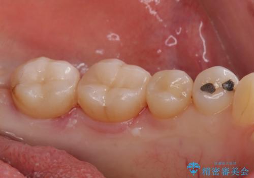 アマルガムを除去 虫歯を除去して、セラミックのつめものにの治療後