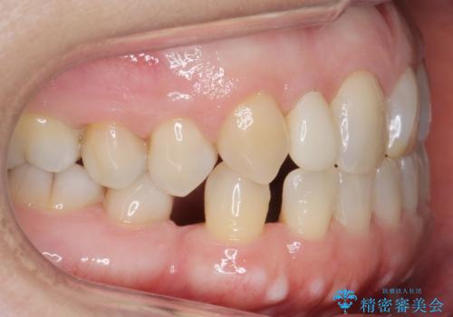 矮小(わいしょう)歯の形をセラミックで自然に 50代女性の治療中