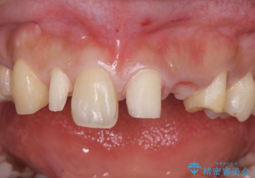 前歯の審美的なブリッジ　(歯列矯正後)の治療中