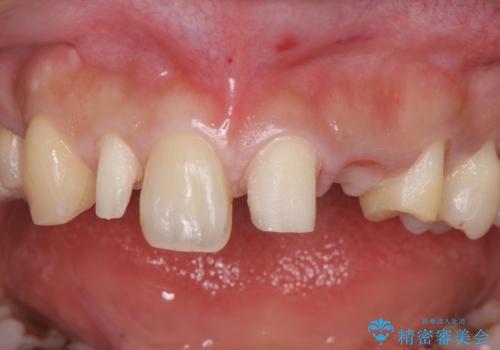 前歯の審美的なブリッジ (歯列矯正後)の治療中