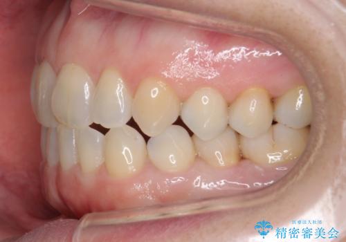 矮小(わいしょう)歯の形をセラミックで自然に 50代女性の治療中