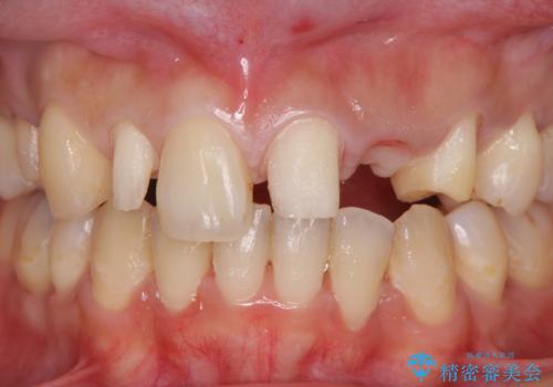 前歯の審美的なブリッジ　(歯列矯正後)の治療中
