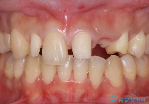 前歯の審美的なブリッジ (歯列矯正後)の治療中