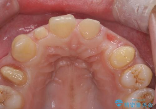 前歯の審美的なブリッジ　(歯列矯正後)の治療中