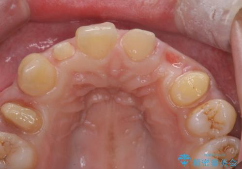 前歯の審美的なブリッジ (歯列矯正後)の治療中