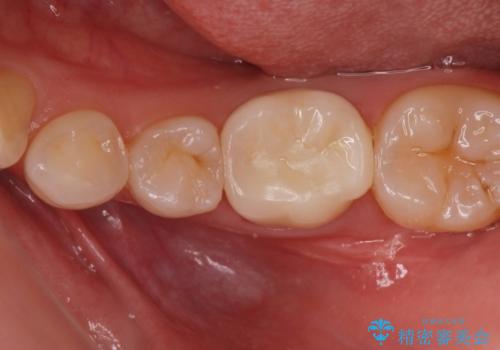 白い被せ物を入れたい。の症例 治療後