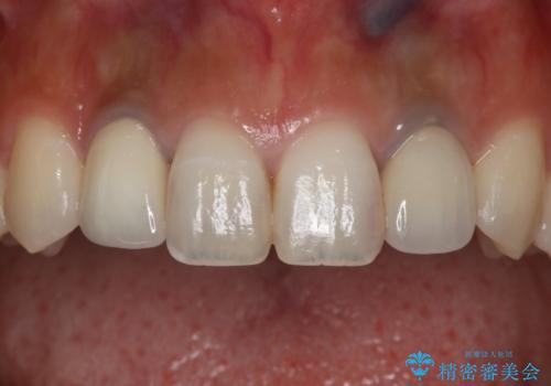 仮歯からセラミックへ 色合わせで自然な色調の再現の症例 治療後
