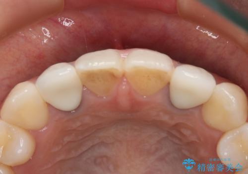 仮歯からセラミックへ　色合わせで自然な色調の再現の治療後
