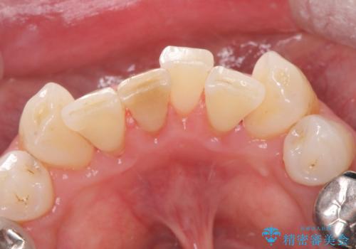 着色が気になる。の治療後