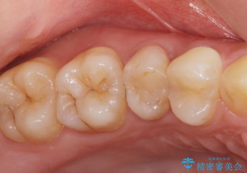 奥歯の神経のない歯をセラミックでしっかり治療