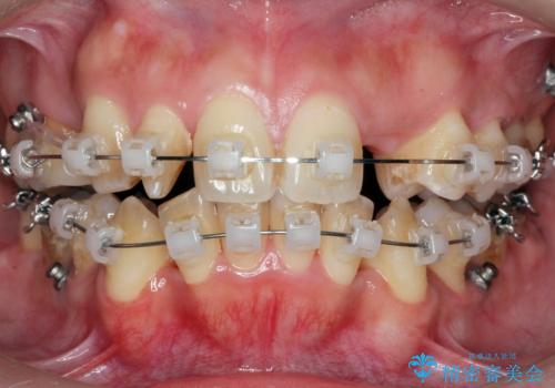 重度のがたつき　矯正治療+セラミック治療で綺麗な歯並びに　矯正専門では難しい治療の治療中