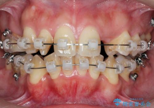 重度のがたつき 矯正治療+セラミック治療で綺麗な歯並びに 矯正専門では難しい治療の治療中