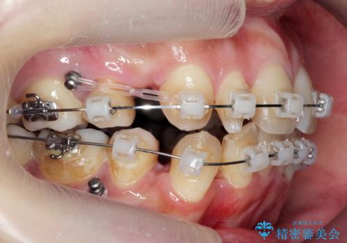重度のがたつき　矯正治療+セラミック治療で綺麗な歯並びに　矯正専門では難しい治療の治療中