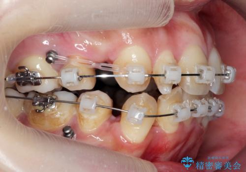 重度のがたつき 矯正治療+セラミック治療で綺麗な歯並びに 矯正専門では難しい治療の治療中
