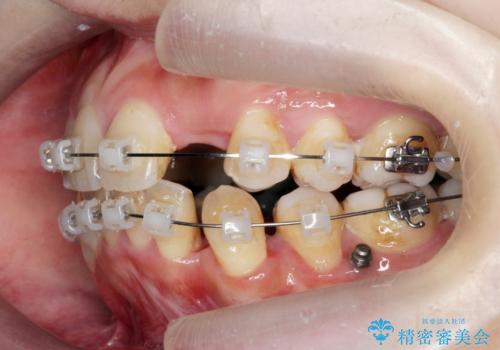 重度のがたつき　矯正治療+セラミック治療で綺麗な歯並びに　矯正専門では難しい治療の治療中