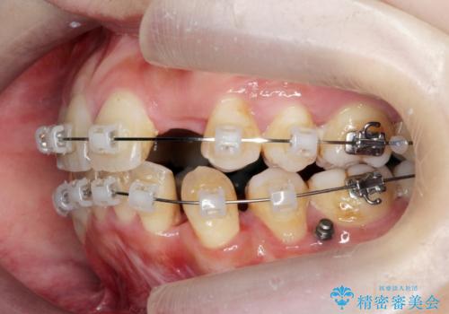 重度のがたつき 矯正治療+セラミック治療で綺麗な歯並びに 矯正専門では難しい治療の治療中