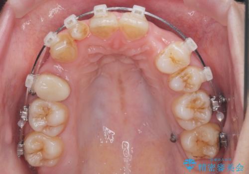 重度のがたつき　矯正治療+セラミック治療で綺麗な歯並びに　矯正専門では難しい治療の治療中