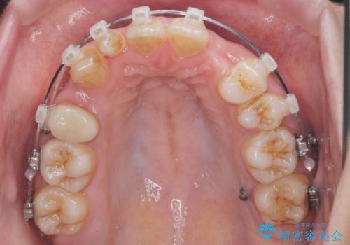 重度のがたつき 矯正治療+セラミック治療で綺麗な歯並びに 矯正専門では難しい治療の治療中