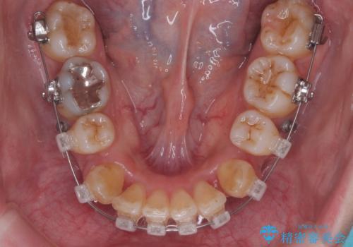 重度のがたつき 矯正治療+セラミック治療で綺麗な歯並びに 矯正専門では難しい治療の治療中