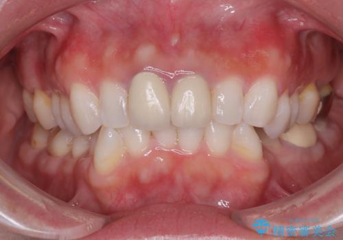 前歯の黄色味が気になる オールセラミッククラウン(スペシャル)の症例 治療前