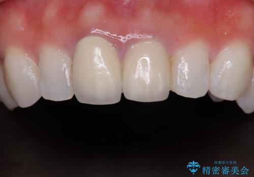 前歯の黄色味が気になる オールセラミッククラウン(スペシャル)の治療前