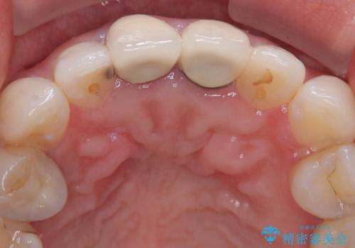 前歯の黄色味が気になる オールセラミッククラウン(スペシャル)の治療前