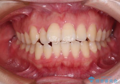 飛び出した上顎前歯 抜歯矯正で横顔の印象を改善の症例 治療前