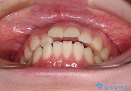 飛び出した上顎前歯 抜歯矯正で横顔の印象を改善の治療前